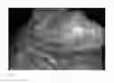 Fig. 05 - Method for evaluating blush in myocardial tissue