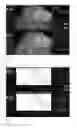 Fig. 06 - Method for evaluating blush in myocardial tissue