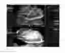 Fig. 07 - Method for evaluating blush in myocardial tissue