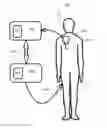 Fig. 16 - Devices and methods for measurement of Vena Cava dimensions, pressure and oxygen saturation