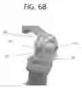 Fig. 22 - Orthopedic joint distraction device