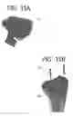 Fig. 32 - Orthopedic joint distraction device