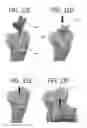 Fig. 33 - Orthopedic joint distraction device