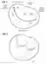 Fig. 02 - Transcatheter heart valve leaflet plication