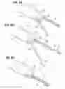 Fig. 05 - Transcatheter heart valve leaflet plication