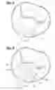 Fig. 07 - Transcatheter heart valve leaflet plication