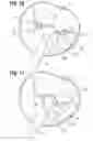 Fig. 08 - Transcatheter heart valve leaflet plication