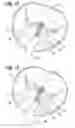 Fig. 09 - Transcatheter heart valve leaflet plication