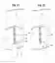 Fig. 14 - Transcatheter heart valve leaflet plication