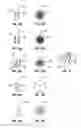 Fig. 07 - IMPLANT AND METHOD FOR FACET IMMOBILIZATION