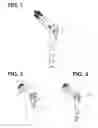Fig. 02 - Active fracture compression implants