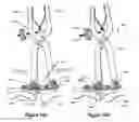 Fig. 06 - Compression plate kit and methods for repairing bone discontinuities