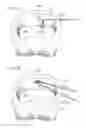 Fig. 09 - HERNIA REPAIR DEVICE, SYSTEM AND METHOD