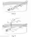 Fig. 04 - Prosthetic repair system and method of use