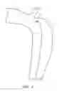 Fig. 02 - Percutaneous method and device to treat dissections