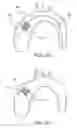 Fig. 07 - Vertical coaptation zone in a planar portion of prosthetic heart valve leaflet