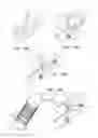 Fig. 22 - Post-implantation tensioning in cardiac implants
