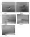 Fig. 02 - Compositions and Methods for Treating and Removing Seborrheic Keratoses