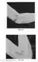 Fig. 08 - Apparatus operable to protect and maintain positioning of an IV catheter