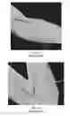 Fig. 09 - Apparatus operable to protect and maintain positioning of an IV catheter