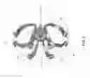 Fig. 07 - Method and apparatus for treating ascites