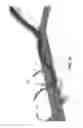 Fig. 35 - Method and apparatus for treating ascites