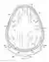 Fig. 19 - Surgical method for implantable neurostimulation system for pain