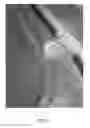 Fig. 02 - LEAF AND DEBRIS FILTER FOR SWIMMING POOL