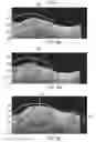 Fig. 10 - Systems and methods to detect and display endovascular features