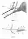 Fig. 14 - STEARABLE MICRO-ENDOSCOPE AND ZIP CATHETER