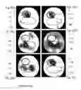 Fig. 03 - Method and apparatus for the non-invasive measurement of pulse transit times (PTT)