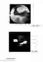Fig. 04 - Method and apparatus for the non-invasive measurement of pulse transit times (PTT)