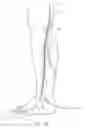 Fig. 15 - Systems and methods for treatment of perforator veins for venous insufficiency