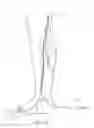 Fig. 17 - Systems and methods for treatment of perforator veins for venous insufficiency