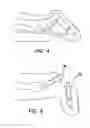 Fig. 04 - Apparatus and method for use in the treatment of hammertoe