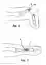 Fig. 05 - Apparatus and method for use in the treatment of hammertoe