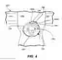 Fig. 06 - Pectus bar and stabilizer devices and methods