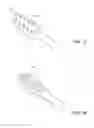 Fig. 10 - Treating upper airway nerve tissue