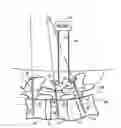 Fig. 01 - METHODS AND APPARATUS FOR SPINAL RECONSTRUCTIVE SURGERY AND MEASURING SPINAL LENGTH AND INTERVERTEBRAL SPACING, TENSION AND ROTATION