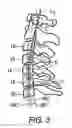 Fig. 04 - METHODS AND APPARATUS FOR SPINAL RECONSTRUCTIVE SURGERY AND MEASURING SPINAL LENGTH AND INTERVERTEBRAL SPACING, TENSION AND ROTATION