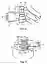Fig. 06 - METHODS AND APPARATUS FOR SPINAL RECONSTRUCTIVE SURGERY AND MEASURING SPINAL LENGTH AND INTERVERTEBRAL SPACING, TENSION AND ROTATION