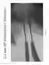 Fig. 09 - METHODS AND APPARATUS FOR SPINAL RECONSTRUCTIVE SURGERY AND MEASURING SPINAL LENGTH AND INTERVERTEBRAL SPACING, TENSION AND ROTATION