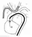 Fig. 01 - Methods and devices for embolic protection