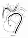 Fig. 02 - Methods and devices for embolic protection