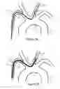 Fig. 03 - Methods and devices for embolic protection