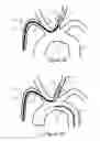 Fig. 04 - Methods and devices for embolic protection