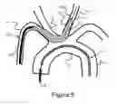 Fig. 07 - Methods and devices for embolic protection