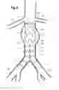 Fig. 05 - Bifurcated prosthesis with an internal limb