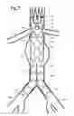 Fig. 06 - Bifurcated prosthesis with an internal limb