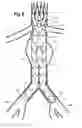 Fig. 07 - Bifurcated prosthesis with an internal limb